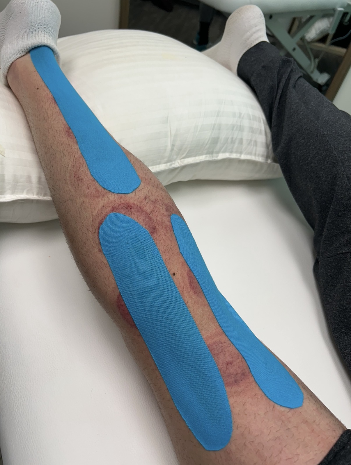 Blue kinesiology tape applied along a patient’s lower leg